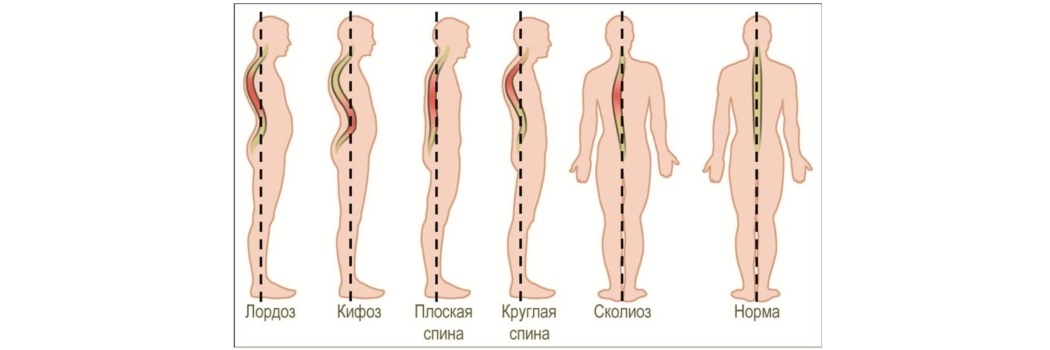 искривления позвоночника.jpg искривления позвоночника.jpg